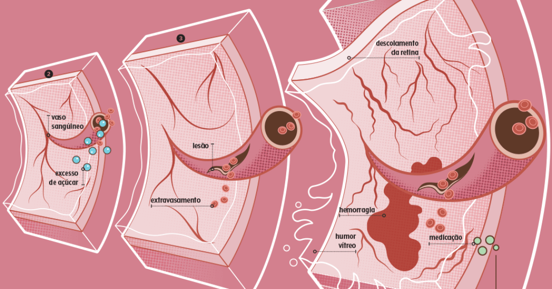 O que é a retinopatia diabética? Problema pode causar cegueira